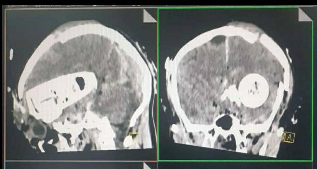 TOMOGRAFÍA QUE SEGÚN LA CONFENIAE DEMUESTRA QUE BYRON HUATATOCA FALLECIÓ POR EL IMPACTO DE UNA BOMBA LAGRIMÓGENA